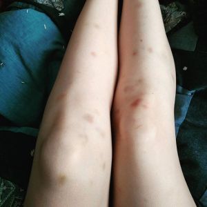 bruises